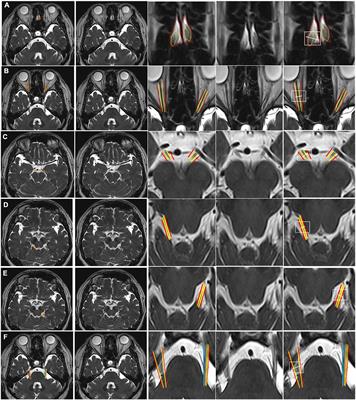 All Central Nervous System Neuro- and Vascular-Communication Channels Are Surrounded With Cerebrospinal Fluid